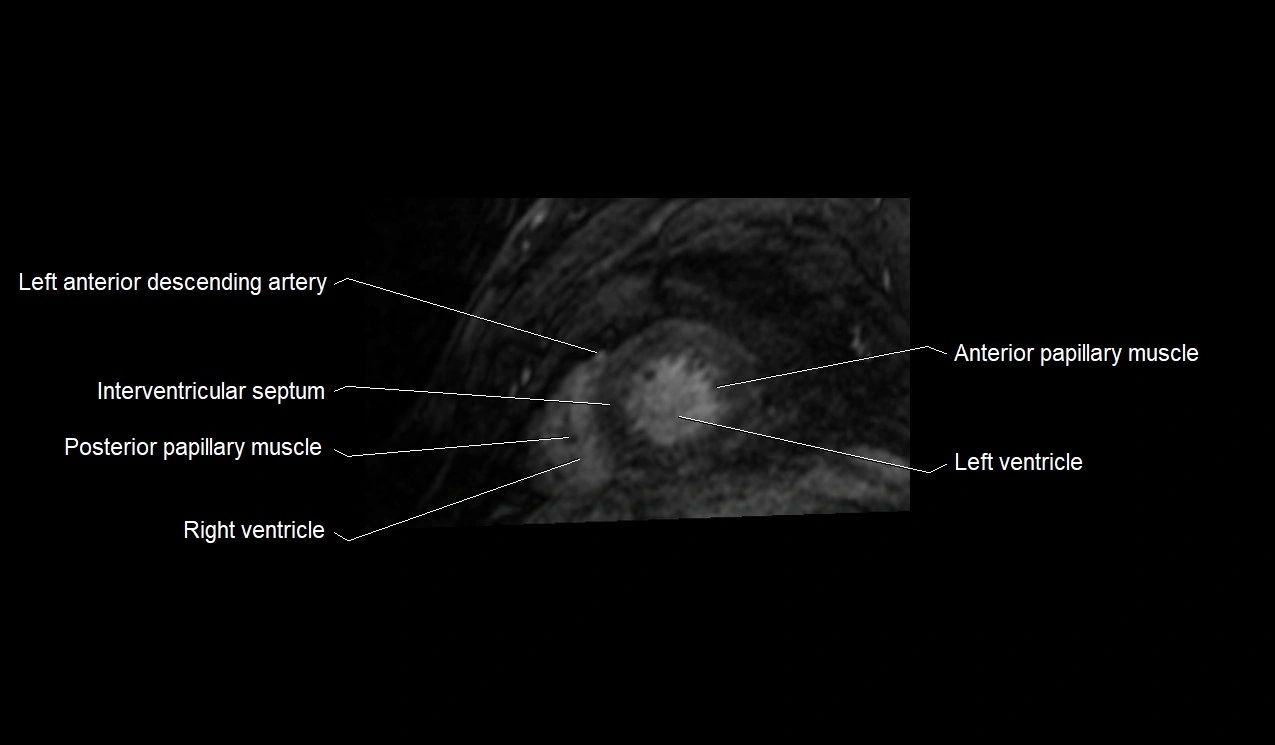 MRI heart and coronary arteries short axis anatomy image 33.webp